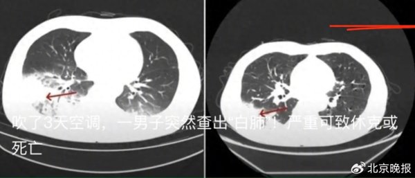 博盈配资 空调吹成白肺？这个致病菌到底从何而来